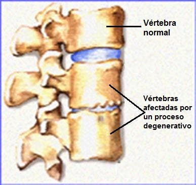 Qué es el síndrome facetario Síntomas diagóstico y tratamiento