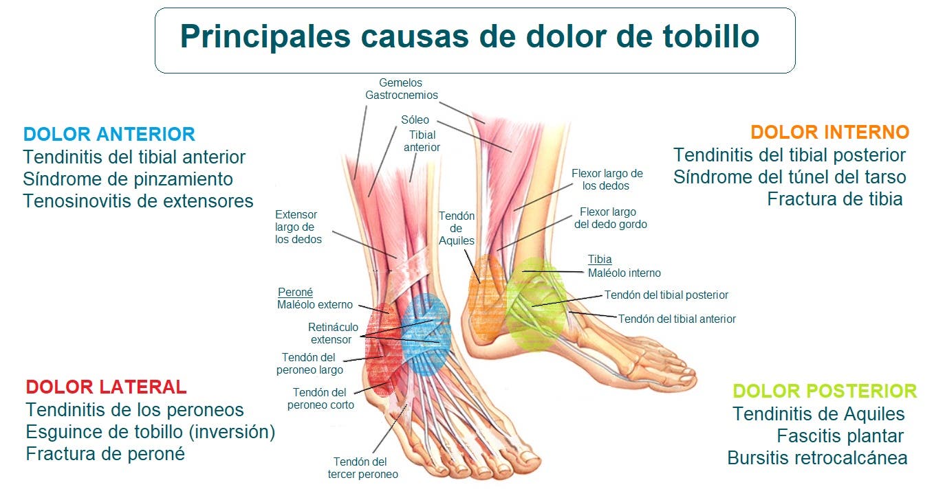 Dolor de tobillo Qué es causas síntomas tratamiento y consejos