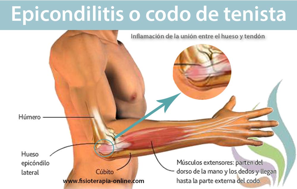 Epicondilitis Epicondilalgia El Martirizante Codo De Tenista