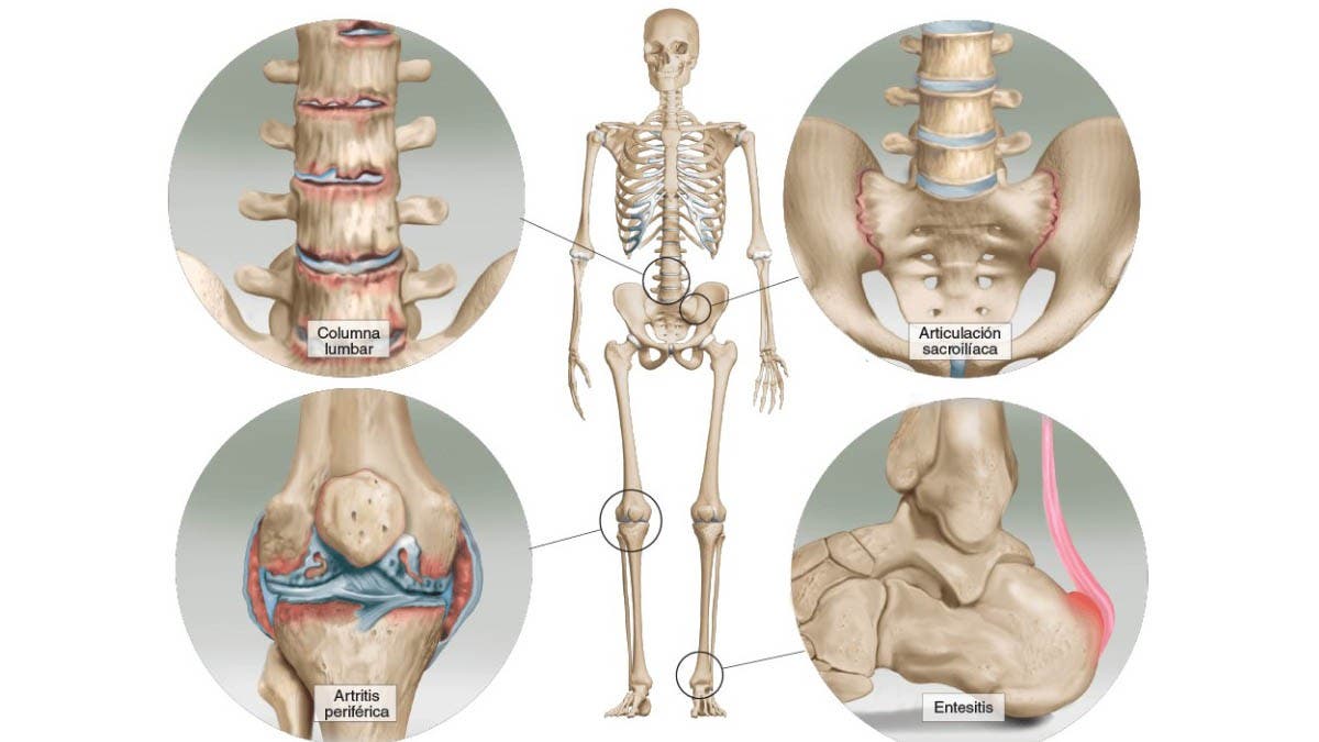 Espondilitis Anquilopoy Tica Qu Es Causas S Ntomas Tratamiento Y