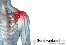 Desgarro o rotura del manguito rotador del hombro Causas síntomas y
