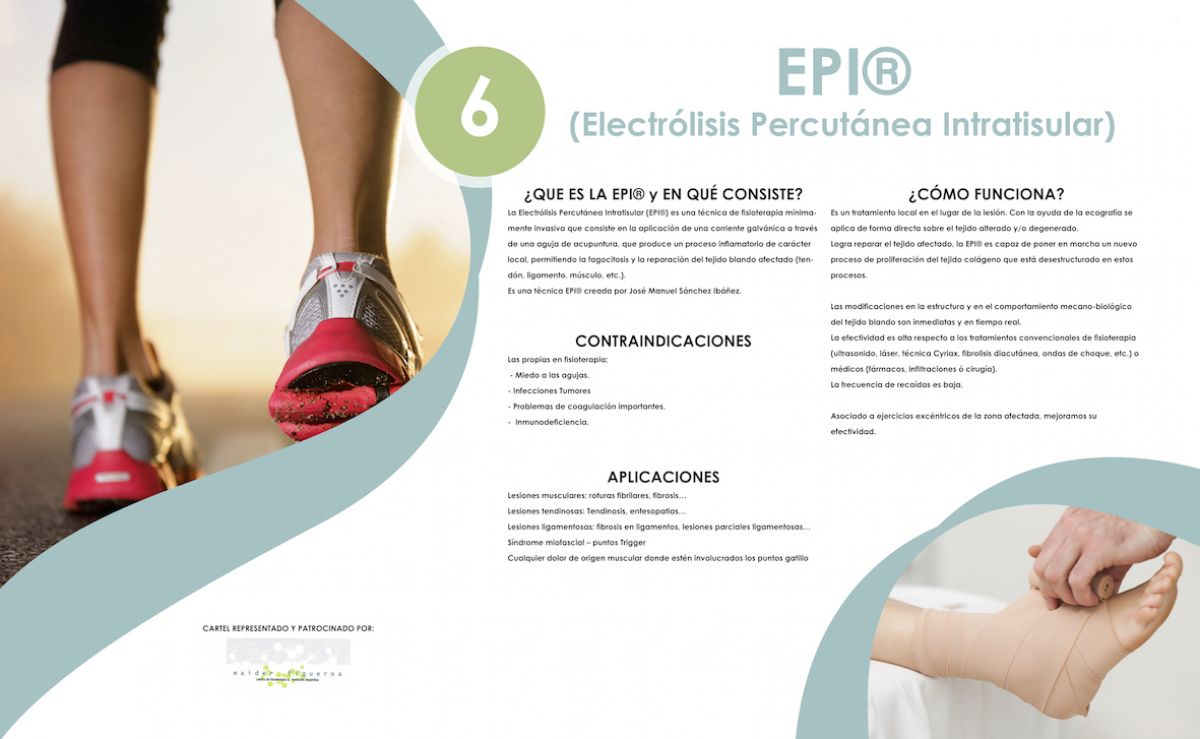 Electrolisis Percutanea Intratisular Qué es y qué puede hacer para