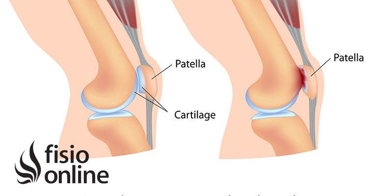 Fisioterapia bursitis rodilla