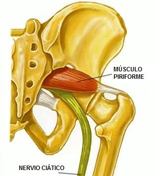 ¿Qué es una falsa ciática o ciática por síndrome del piramidal?