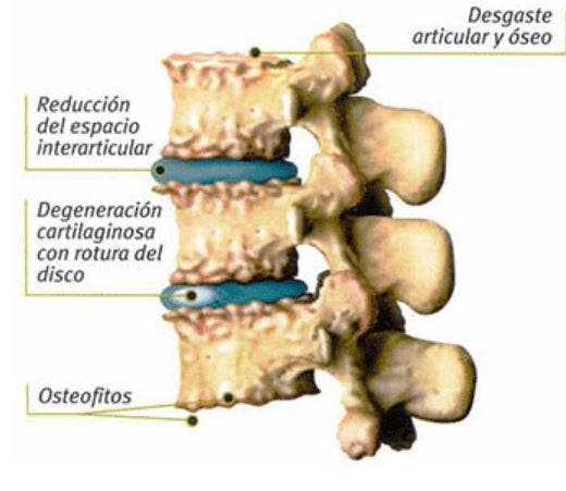 Artrosis Cervical