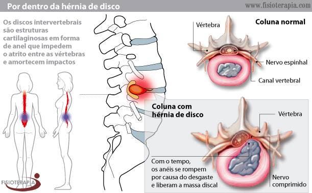 Conoce Todo Lo Que Necesitas Saber Sobre Las Hernias De Disco Causas Consecuencias Síntomas Y 7392