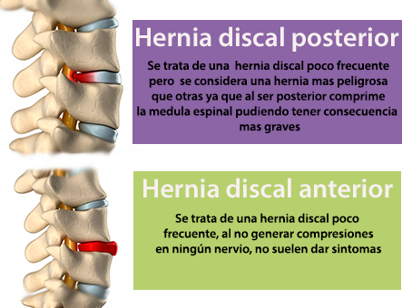 Las hernias discales pueden ser muy diferentes, aprende cómo son algunas de  ellas
