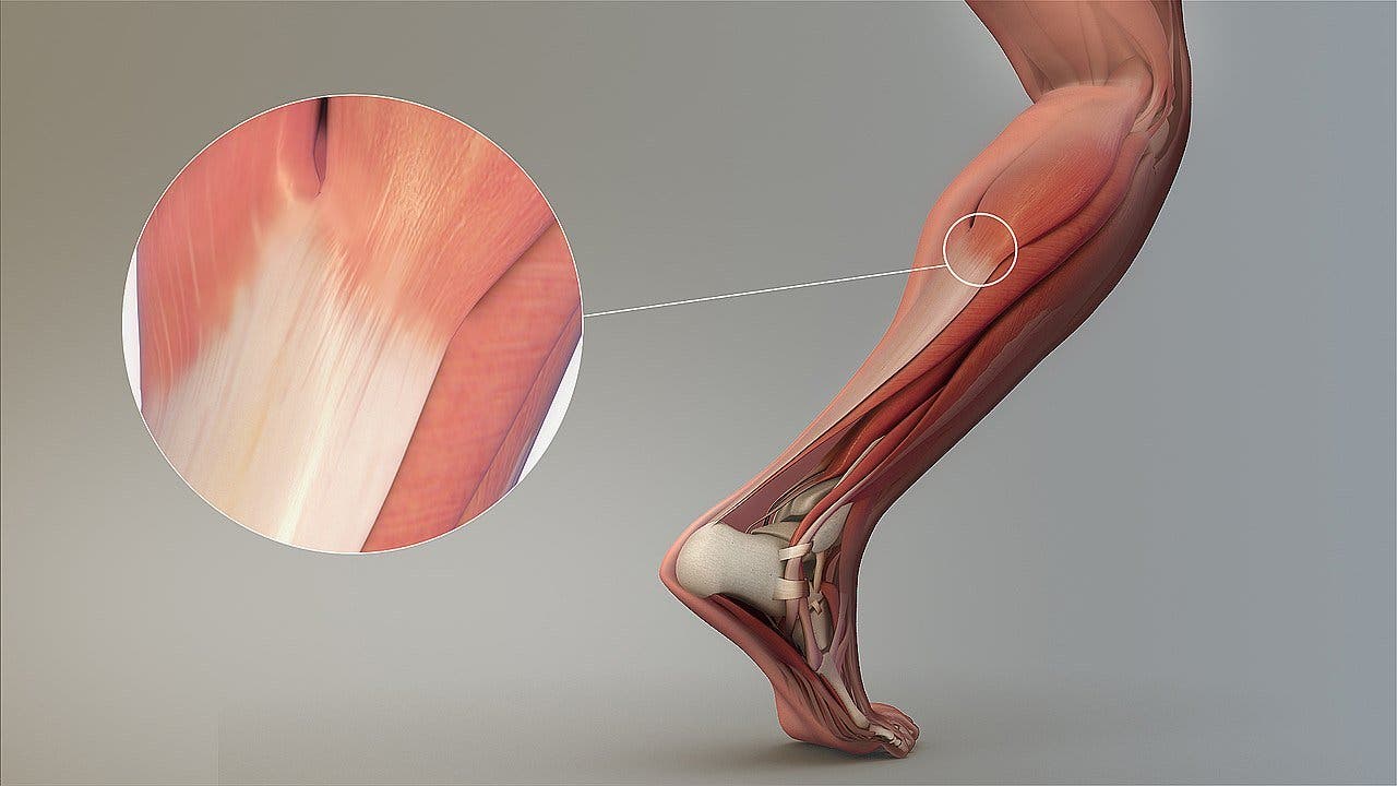 Lesiones De Tendón Cuales Son Sus Diferentes Tipos Y Su Recuperación Fisioonline 4688
