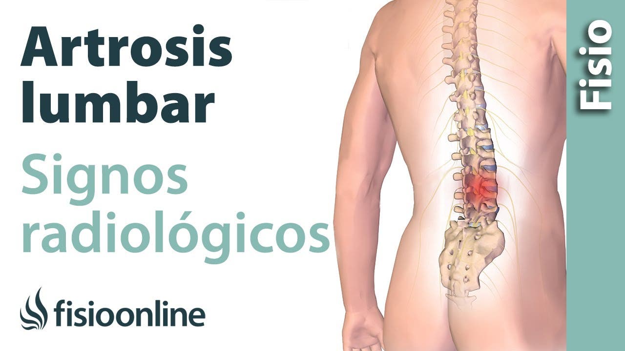 Preguntas frecuentes sobre la artrosis de columna lumbar - Clínica InDolore