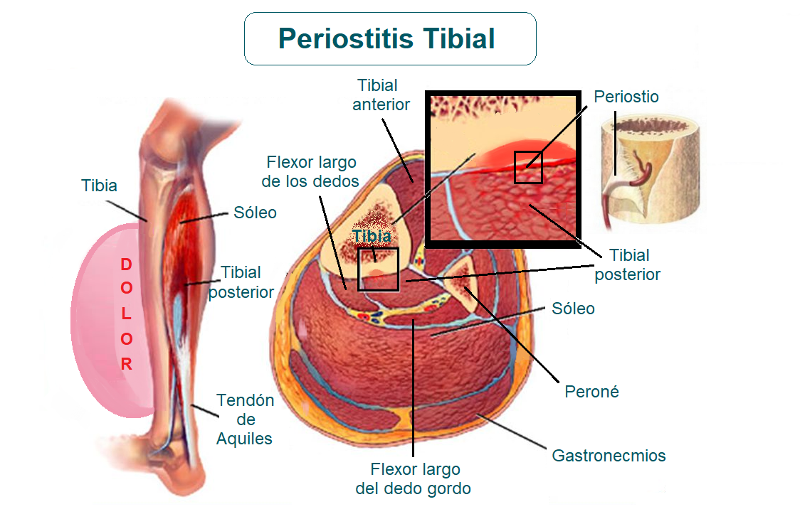Periostitis Tibial Qué Es Causas Síntomas Tratamiento Y Consejos Fisioonline 0154