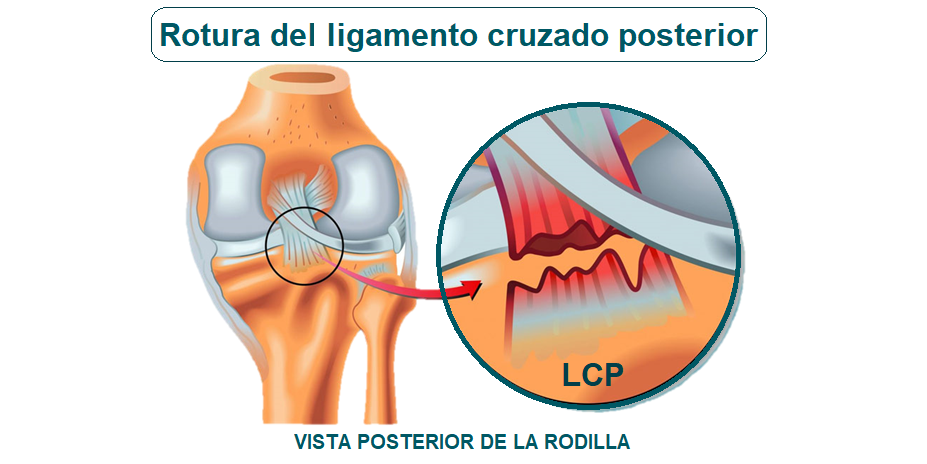 Rotura De Ligamentos Cruzados Qué Es Causas Síntomas Tratamiento Y Consejos Fisioonline