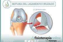 Rotura del ligamento cruzado de la rodilla, información consejos y un útil vídeo sobre el tema