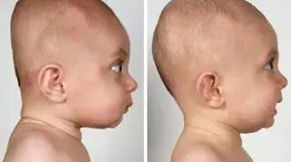 Cojin plagiocefalia para evitar deformidades craneales - El Recien NacidoEl  Recien Nacido
