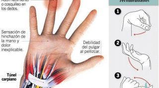 El síndrome del túnel carpiano, aprende qué es, cómo se produce y qué hacer para tratarlo