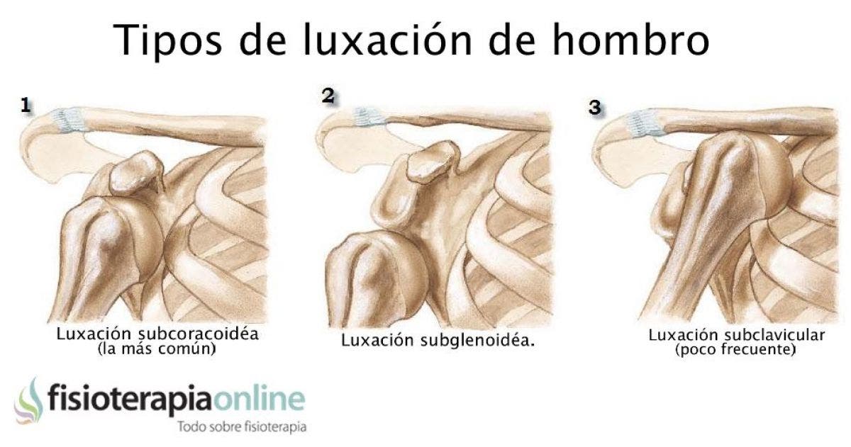 Luxación De Hombro. Qué Es Y Cuales Son Sus Tipos | Fisioterapia Online