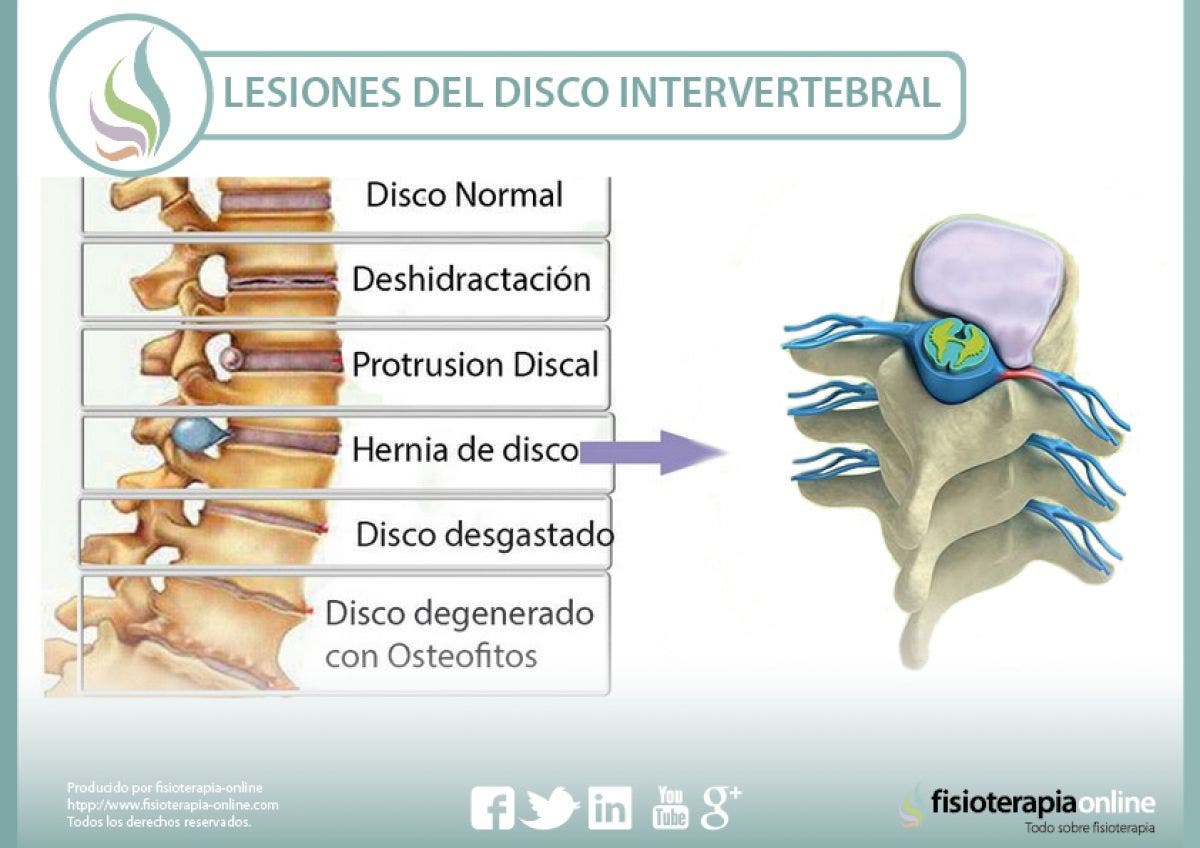 Lesiones Más Frecuentes Del Disco Intervertebral | FisioOnline