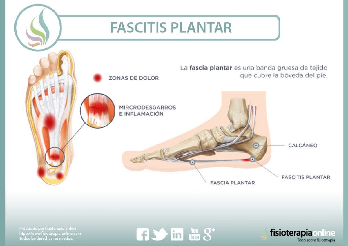 Fascitis plantar causas Idea