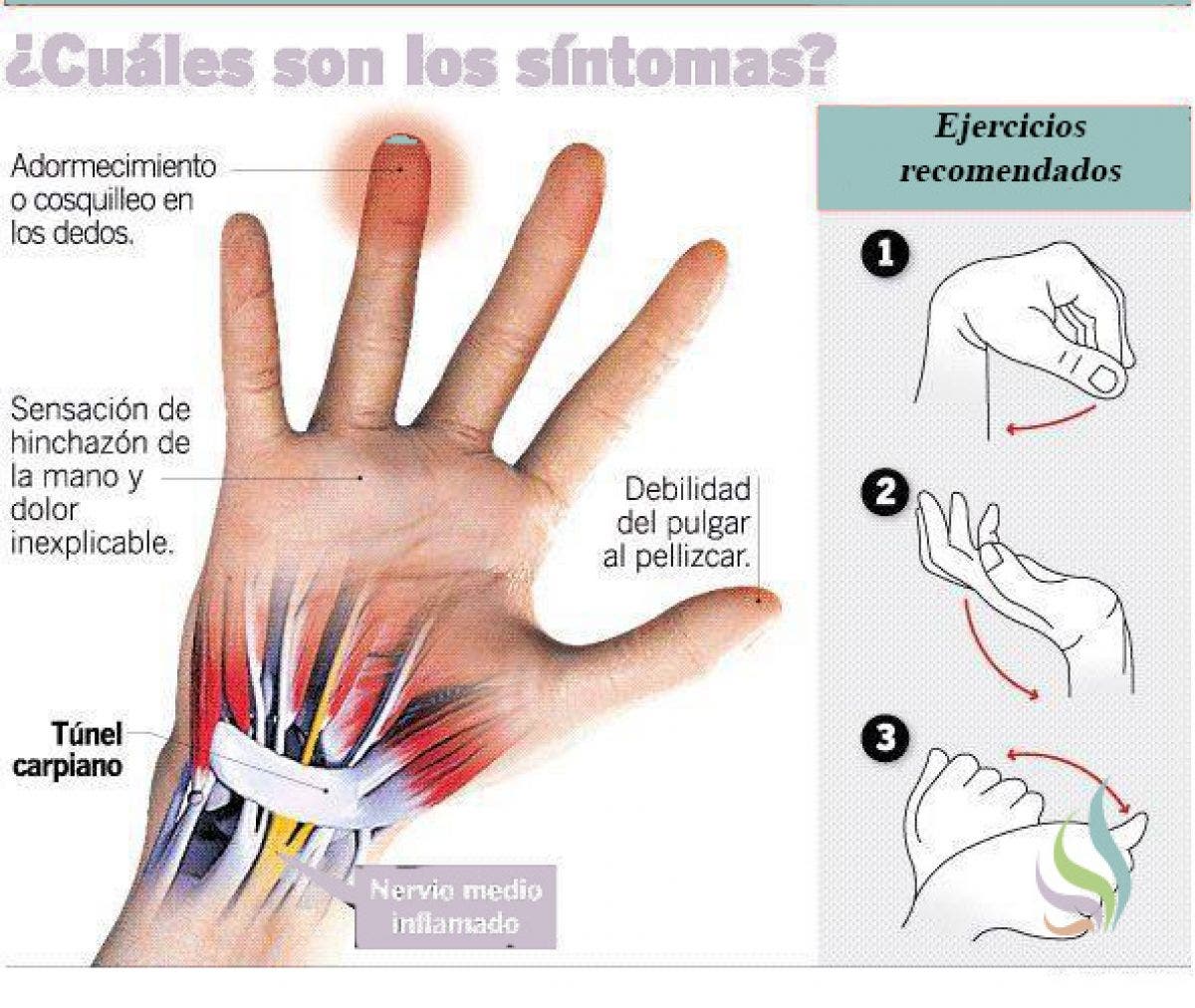 El Síndrome Del Túnel Carpiano, Aprende Qué Es, Cómo Se Produce Y Qué ...