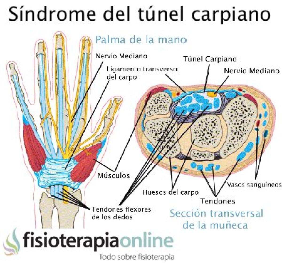 Síndrome Del Túnel Carpiano. Causas Y Tratamiento | FisioOnline