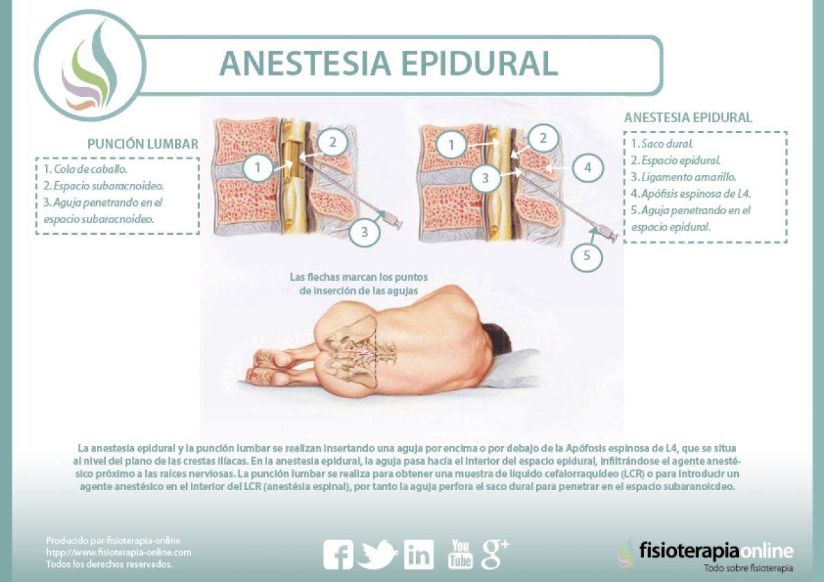 Anestesia epidural, descubre sus indicaciones y sus peligros