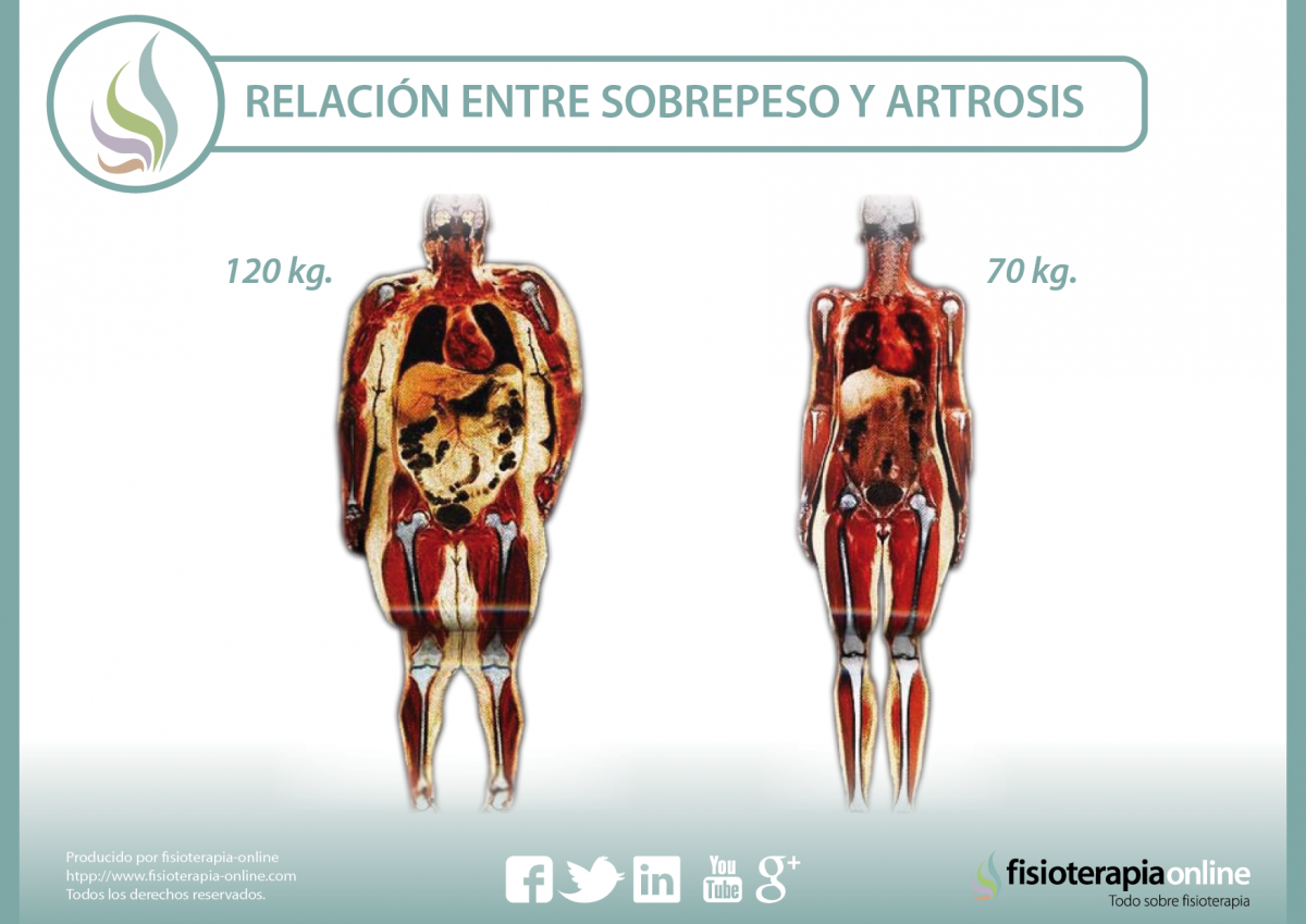 Sobrepeso y artrosis