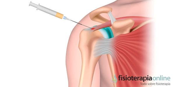 Beneficios del plasma rico en plaquetas en lesiones articulares, indicaciones, contraindicaciones y efectos terapéuticos