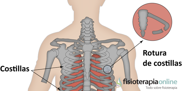 ¿Cómo se pueden disminuir las complicaciones ocasionadas por las fracturas de costillas?