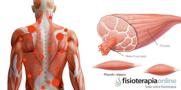 ¿Qué cambios debo hacer para evitar una contractura muscular de espalda?