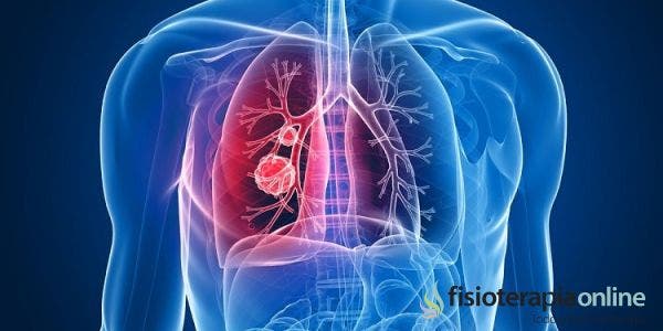 ¿Cuáles son los síntomas y los signos de la Fibrosis Quística?