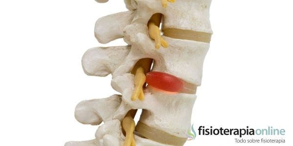 Causas, diagnóstico y tratamiento integrativo para la hernia discal lumbar 