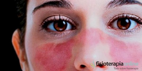 ¿Cómo vivir con lupus eritematoso?