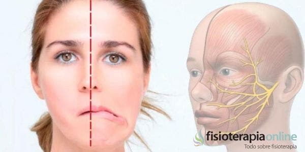 ¿Qué ejercicios puedo hacer si tengo Parálisis Facial?