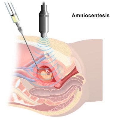 SÃ­ndrome de Down. Tratamiento y ejercicios en fisioterapia