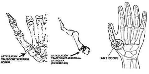 Consejos para convivir con la rizartrosis. Ortopedia Plantia de  Donostia-San Sebastian – Ortopedia Plantia – Donostia San Sebastián