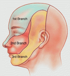 Tipos de neuralgias