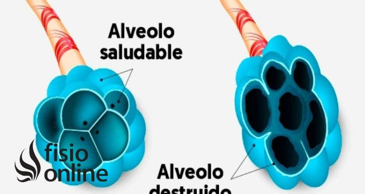 Enfisema Pulmonar | Qué Es, Qué Estructuras Afecta, Síntomas, Signos ...