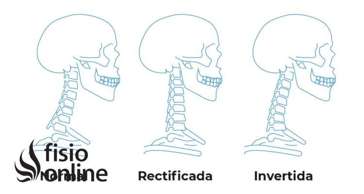 Cervical rectificada como fashion dormir