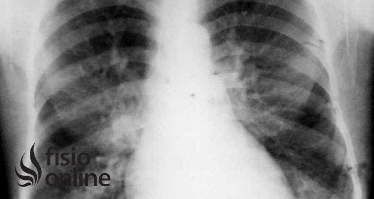 Bronquiolitis: Síntomas y Tratamiento de Fisioterapia