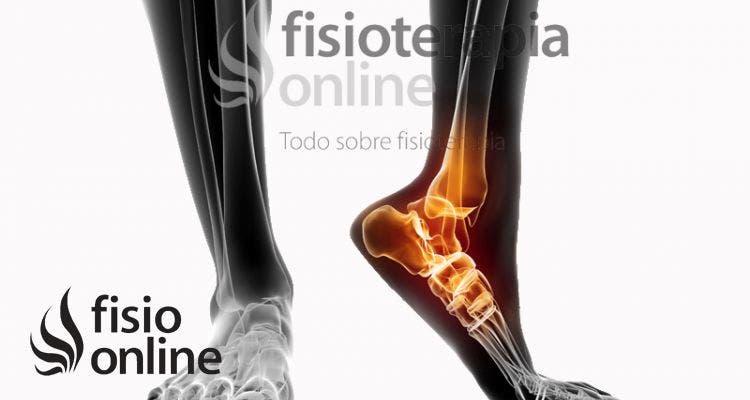 ¿Qué es la Bursitis Calcánea? | Fisioterapia Online