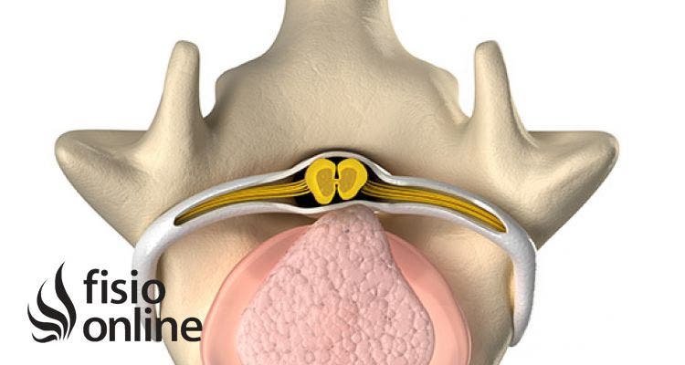 ¿Qué es una Hernia Discal? Causas y síntomas