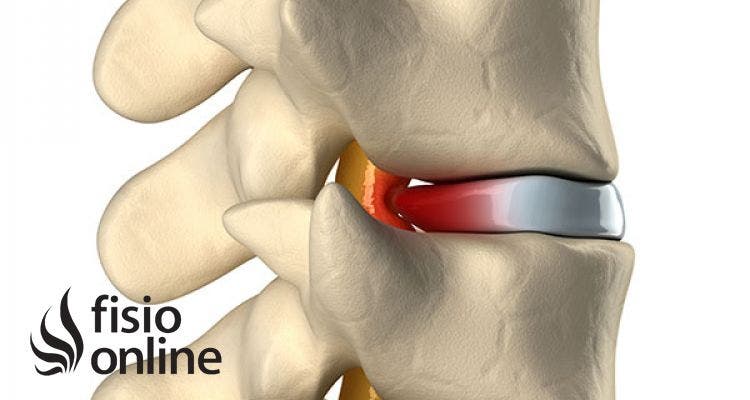 Hernia discal central a nivel L5 S. Causas s ntomas y tratamiento