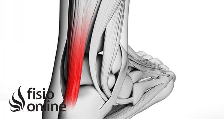 Qué Es La Tendinitis Del Tendón De Aquiles Y Cuales Son Sus Causas ...