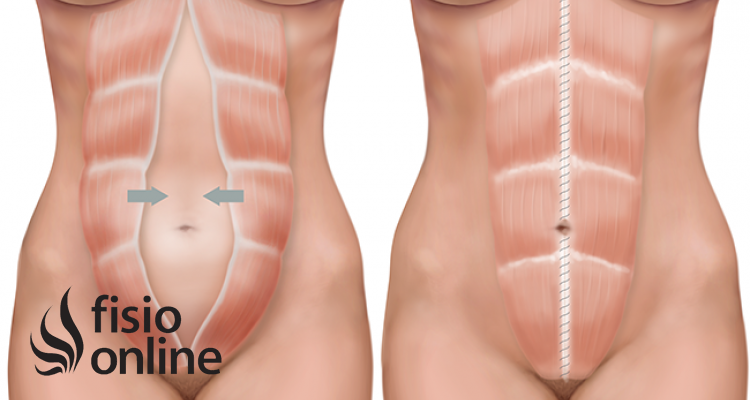 Tipos de hernia umbilical