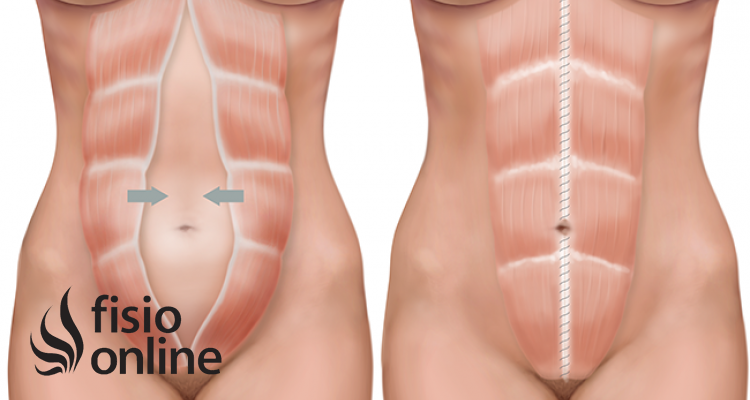 Giros - El dolor en la parte baja del vientre suele estar