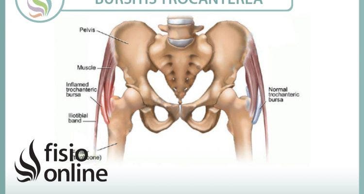 Conoce la bursitis trocantérea o trocanteritis