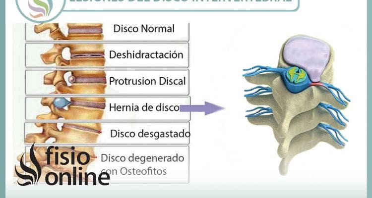 Lesiones más frecuentes del disco intervertebral