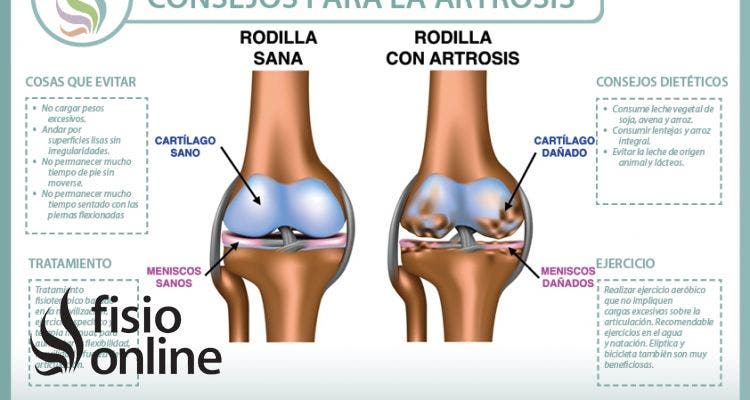 Consejos para tratar la artrosis