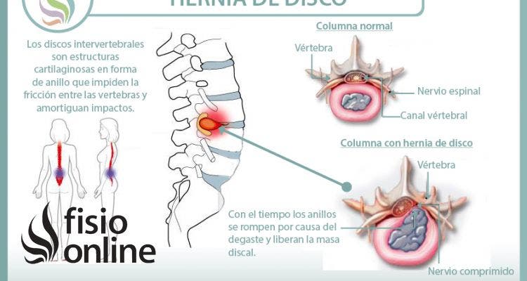 Conoce todo lo que necesitas saber sobre las hernias de disco, causas, consecuencias, síntomas y tratamiento desde la fisioterapia