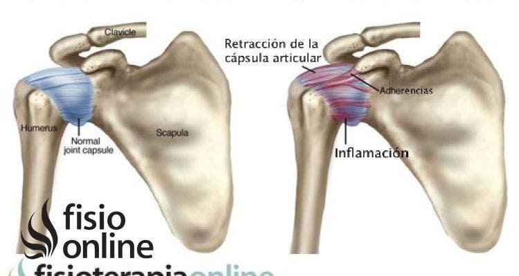 Hombro congelado o capsulitis adhesiva, unos útiles consejos e información para que sepas cómo afrontarlo