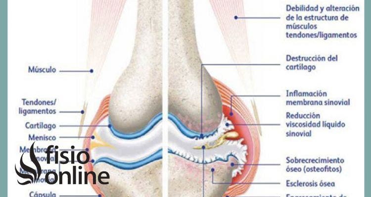 Artrosis, degeneración del cartílago articular, una serie de recomendaciones, reflexiones y consejos sobre el tema